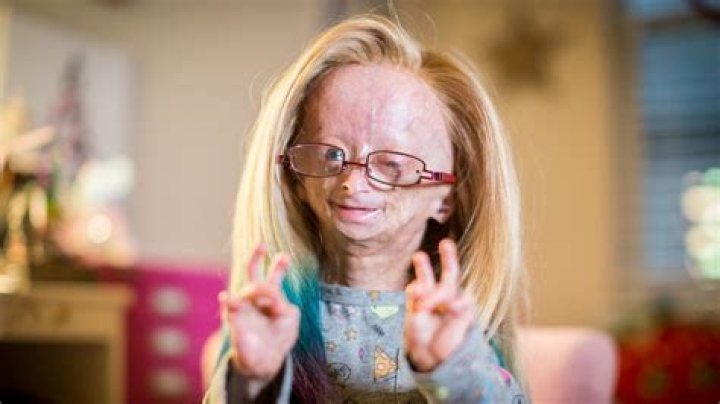 Adalia Rose Biography - Facts, Childhood, Family Life & Achievements