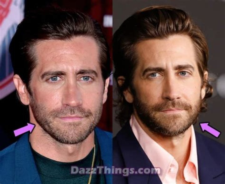 Jake Gyllenhaal Plastic Surgery Before and After