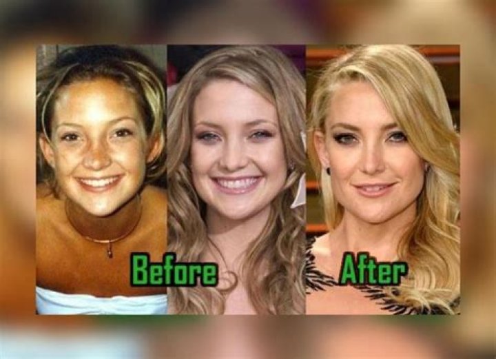Kate Hudson Plastic Surgery: Hudson's Approach and Story of Undergoing Procedures!