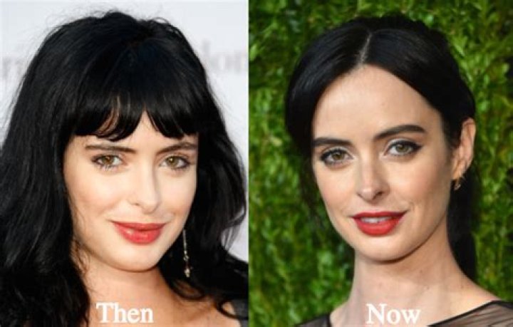 Krysten Ritter Plastic Surgery Before and After