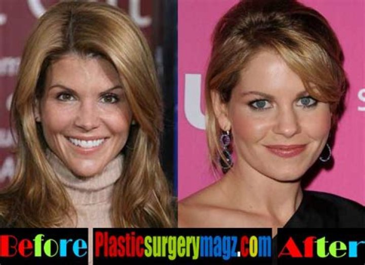 Lori Loughlin Plastic Surgery Before and After