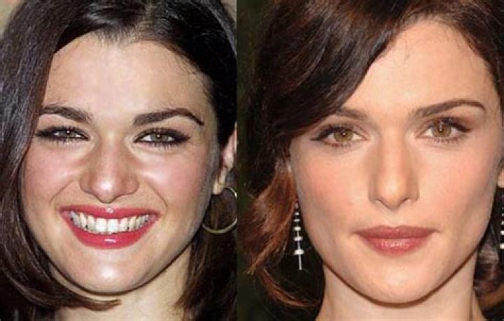 Rachel Weisz Facelift Plastic Surgery Before and After