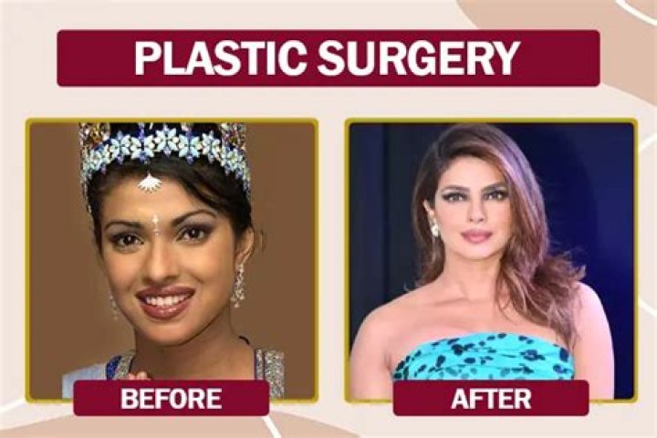 Sherlyn Chopra’s Plastic Surgery: Every Procedures She Has Received!