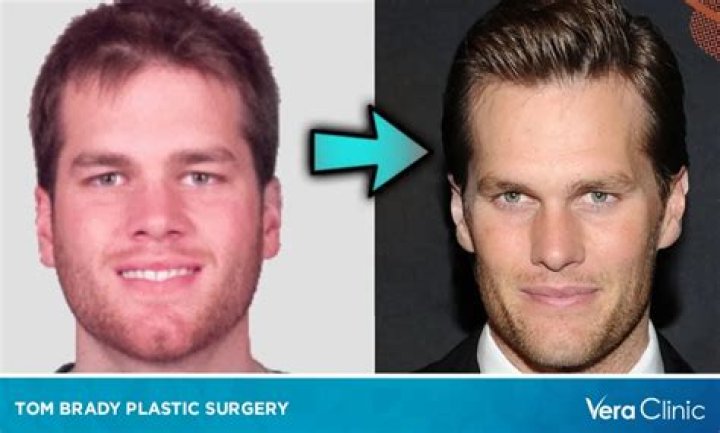 Tom Brady Plastic Surgery: Debunking the Rumors and Analyzing Facial Changes