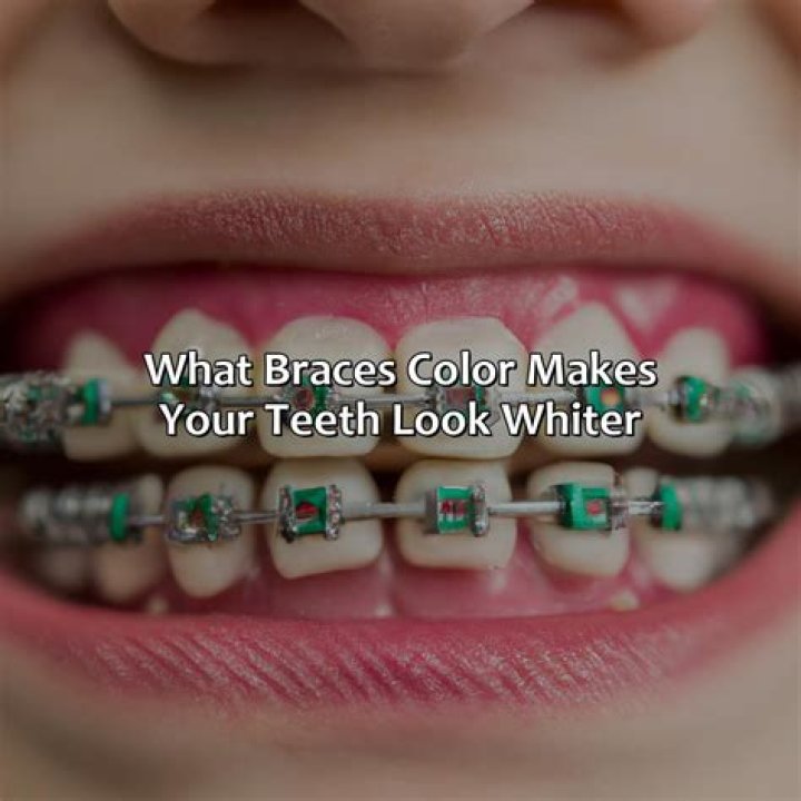 What color braces make teeth look whiter